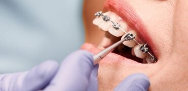 ماجستير تقويم أسنان في ايران